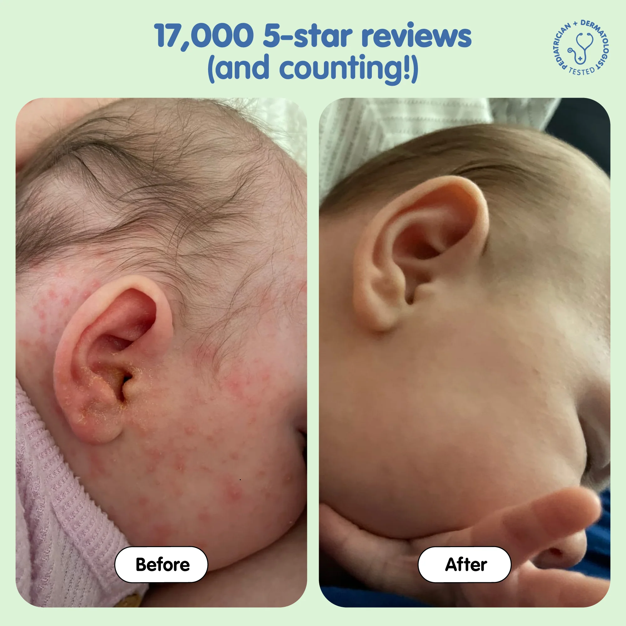 All Over Ointment Eczema Treatment - Image 6